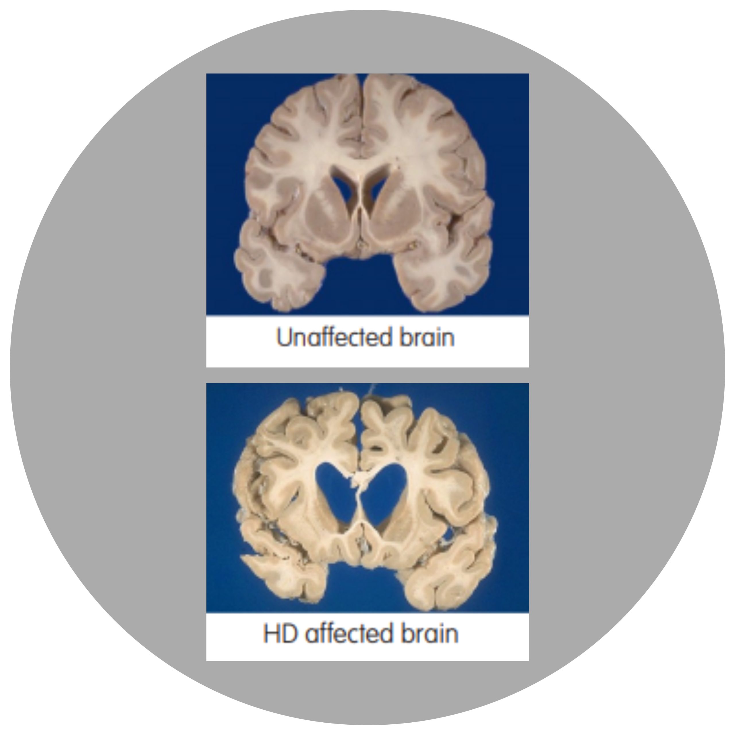 Huntington’s Disease Timeline – Huntington's Victoria